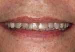 Full Mouth Rehabilitation Before Smile