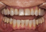 Full Mouth Rehabilitation Before Retracted Smile