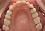 Full Mouth Rehabilitation Before Maxillary Arch