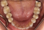 Full Mouth Rehabilitation Before Mandibular Arch