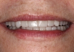 Full Mouth Rehabilitation After Smile