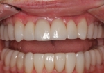 Full Mouth Rehabilitation After Retracted Smile