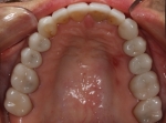 Full Mouth Rehabilitation After Maxillary Arch