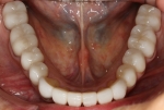 Full Mouth Rehabilitation Before Mandibular Arch