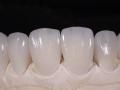 4.Feldspathic Veneers