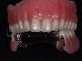 2.New You Denture