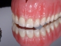 3.New You Denture