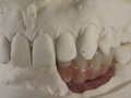 4.Tryin on Model;Screw Retained Zirconia Implant Bridge