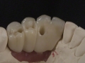 5.Ligual View Try-in on Model;Screw Retained Zirconia Implant Bridge