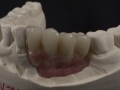 6. Left Lateral View Try-in on Model;Screw Retained Zirconia Implant Bridge