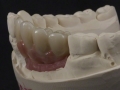 7.Left Lateral View Try-in on Model;Screw Retained Zirconia Implant Bridge