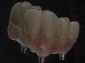 8.Screw Retained Zirconia Implant Bridge