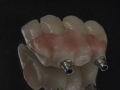 9. Screw Retained Zirconia Implant Bridge