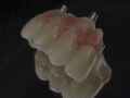 10. Screw Retained Zirconia Implant Bridge