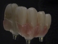 11.Screw Retained Zirconia Implant Bridge