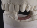 1.Poured Models;Screw Retained Zirconia Implant Bridge