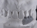 3. Articulated Waxed Models; Screw Retained Zirconia Implant Bridge