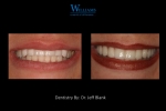 Full Arch Smile Makeover