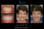 Strickland FOY™ Dentures by Dr. David Lee