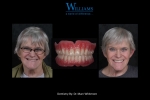 Strickland FOY™ Dentures, by Dr. Marcus Whitmore