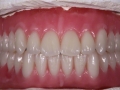 14.Natural FOY™ Dentures