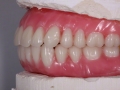 16.Natural FOY™ Dentures